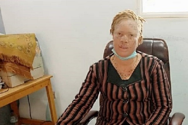 Albinisme : « La majorité des décès d’albinos sont dus au cancer de la peau », Maïmouna Déné, présidente de l’Association des femmes albinos du Burkina