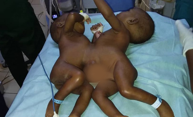 Chirurgie pédiatrique : Des jumeaux siamois séparés avec succès au CHU pédiatrique Charles de Gaulle de Ouagadougou