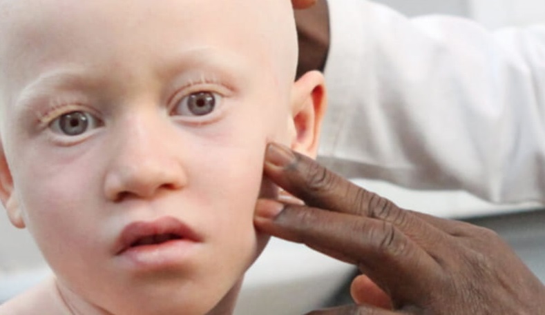  Albinisme : mise à disposition d’une formule de crème de protection solaire par la Fondation Pierre Fabre