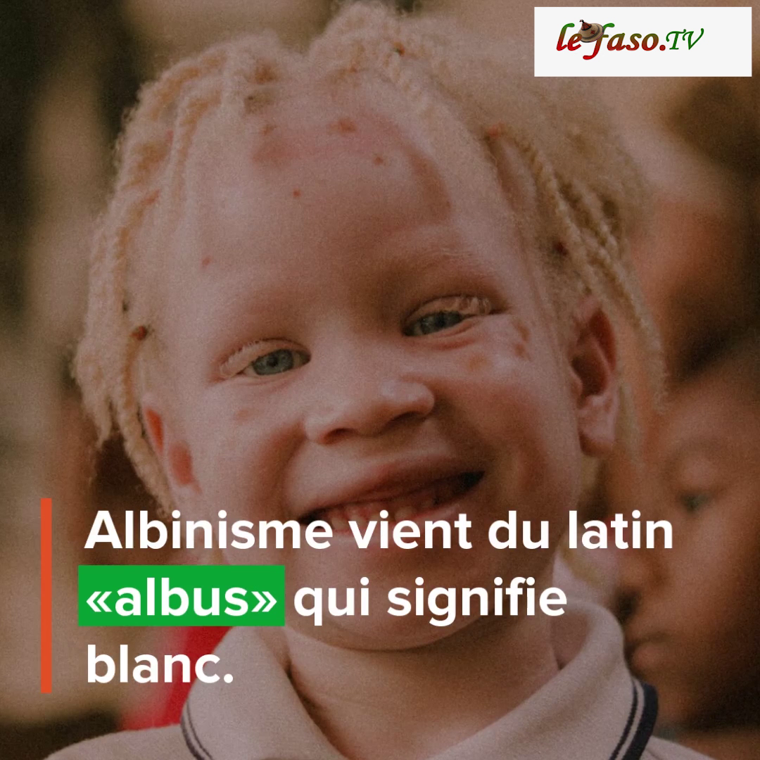 Albinisme : A la découverte d’une maladie rare