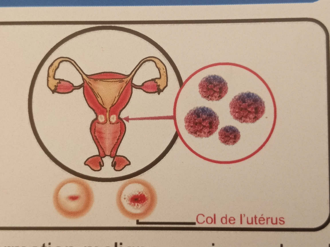 Cancer du col de l’utérus : Les produits éclaircissants, le tabagisme, des causes à l’origine de ce mal