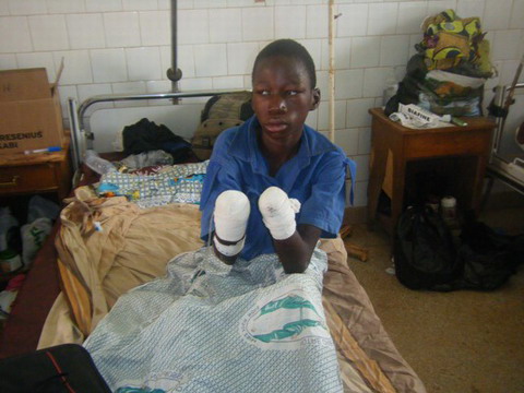 Maltraitance des enfants : Un orphelin ligoté et frappé par son oncle à Tenado voit ses deux mains amputées au CHR de Koudougou.