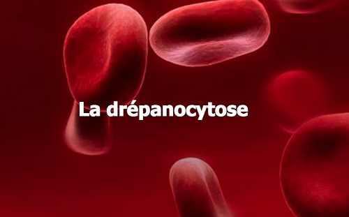 Santé : Ce qu’il faut savoir sur la drépanocytose