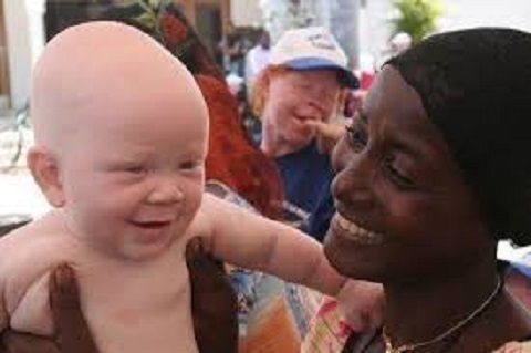 L’Albinisme : quels regards des peuples ?