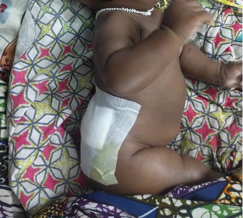 S.O.S pour le petit Abdoul Fatao : L’intervention chirurgicale s’est bien passée