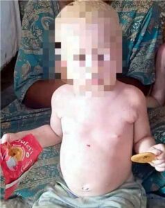Madagascar&nbsp;: L’albinisme toujours au cœur de crimes rituels