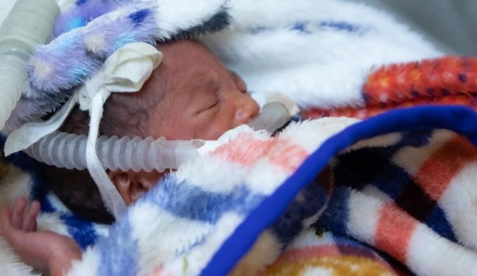 152 millions de bébés nés prématurément au cours de la dernière décennie